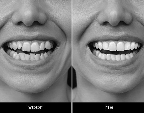 Linde & Co Clear aligners